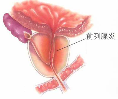 前列腺炎反复发作究竟是什么原因